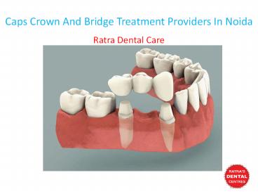 Caps Crown And Bridge Treatment Providers In Noida