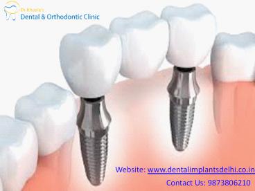 Affordable Dentist in Delhi Dr. Khosla’s Dental Clinic