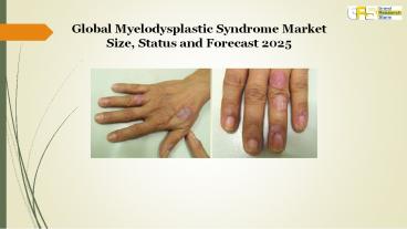Myelodysplastic syndrome market size, status and forecast 2025