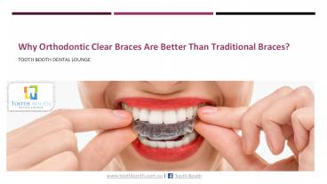 Why Orthodontic Clear Braces Are Better Than Traditional Braces