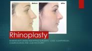 All you need to know about Rhinoplasty`