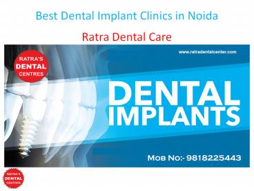 Best Dental Implant Clinics in Noida