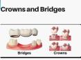 Dental bridges in Pune -  Devs oral care PowerPoint PPT Presentation