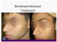 Birthmark Removal Treatment- Karishma Cosmetic PowerPoint PPT Presentation