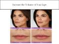 Increase the Volume of Your Lips PowerPoint PPT Presentation