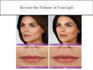 Increase the Volume of Your Lips