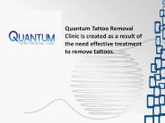 tattoo removal services near me