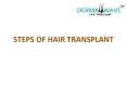 Best Hair Transpalnt Clinic in Kurukshetra PowerPoint PPT Presentation
