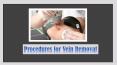 Procedures for Vein Removal PowerPoint PPT Presentation