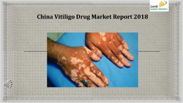 China Vitiligo Drug Market Report 2018