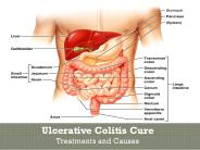 Get Effective Ayurveda Treatment for Ulcerative Colitis