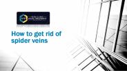 How to get rid of spider veins