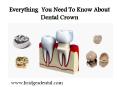 Valrico Dentist: Everything You Need To Know About Dental Crowm PowerPoint PPT Presentation