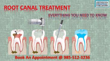 Root Canal Treatment in Tricity