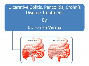 Ayurveda Based Treatment for Ulcerative Colitis by Dr. Harish Verma