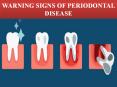 WARNING SIGNS OF PERIODONTAL DISEASE PowerPoint PPT Presentation