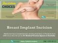 Breast Implant Incision Choice PowerPoint PPT Presentation