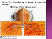 Retinal Vein Occlusion Market Future Outlook-Ken Research