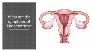 What are the Symptoms of Endometriosis