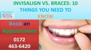 Teeth Braces for Adults