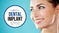 Key Things You Need to Know About Dental Implants PowerPoint PPT Presentation