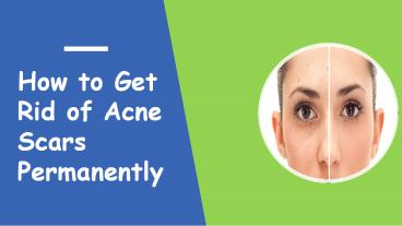 How to Get Rid of Acne Scars Permanantely