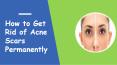 How to Get Rid of Acne Scars Permanantely PowerPoint PPT Presentation