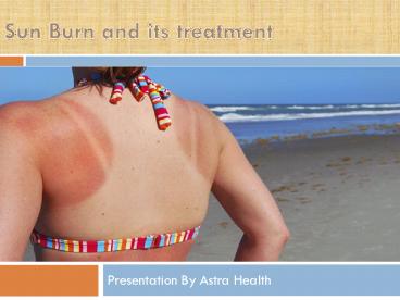 Treatment Of Sun Burn