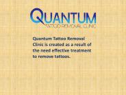 tattoo remove