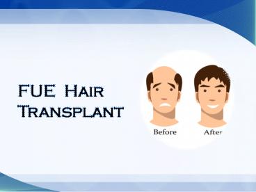 FUE Hair Transplant