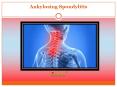 Ankylosing Spondylitis PowerPoint PPT Presentation