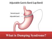 What is Dumping Syndrome?