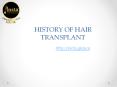 HISTORY OF HAIR TRANSPLANT PowerPoint PPT Presentation