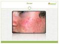 Acne PowerPoint PPT Presentation