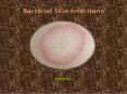 Bacterial Skin Infections : Causes, Symptoms, Treatment and Diagnosis (1) PowerPoint PPT Presentation