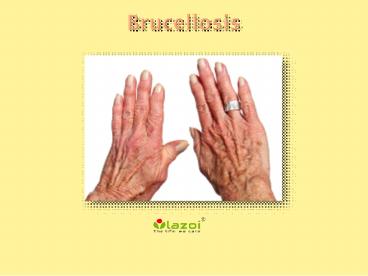 Brucellosis