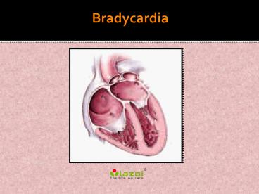Bradycardia