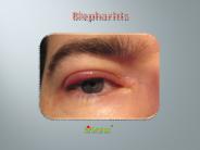 Blepharitis