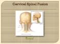 Cervical Spinal Fusion (1) PowerPoint PPT Presentation