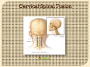 Cervical Spinal Fusion (1)
