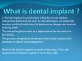 What is Dental Implant | Dr Malvika Jain Dental Clinic PowerPoint PPT Presentation