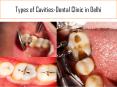 Types of Cavities -Best Dental Clinic in Delhi PowerPoint PPT Presentation