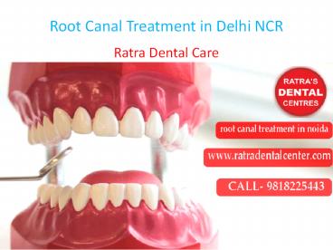 Root Canal Treatment in Delhi NCR