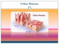 Celiac Disease PowerPoint PPT Presentation