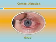 Corneal Abrasion