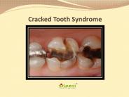 Cracked Tooth Syndrome