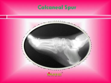 Calcaneal Spur