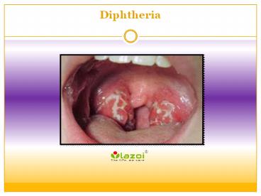 Diphtheria