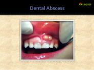 Dental Abscess