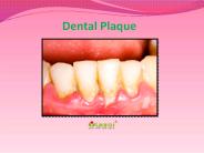 Dental Plaque